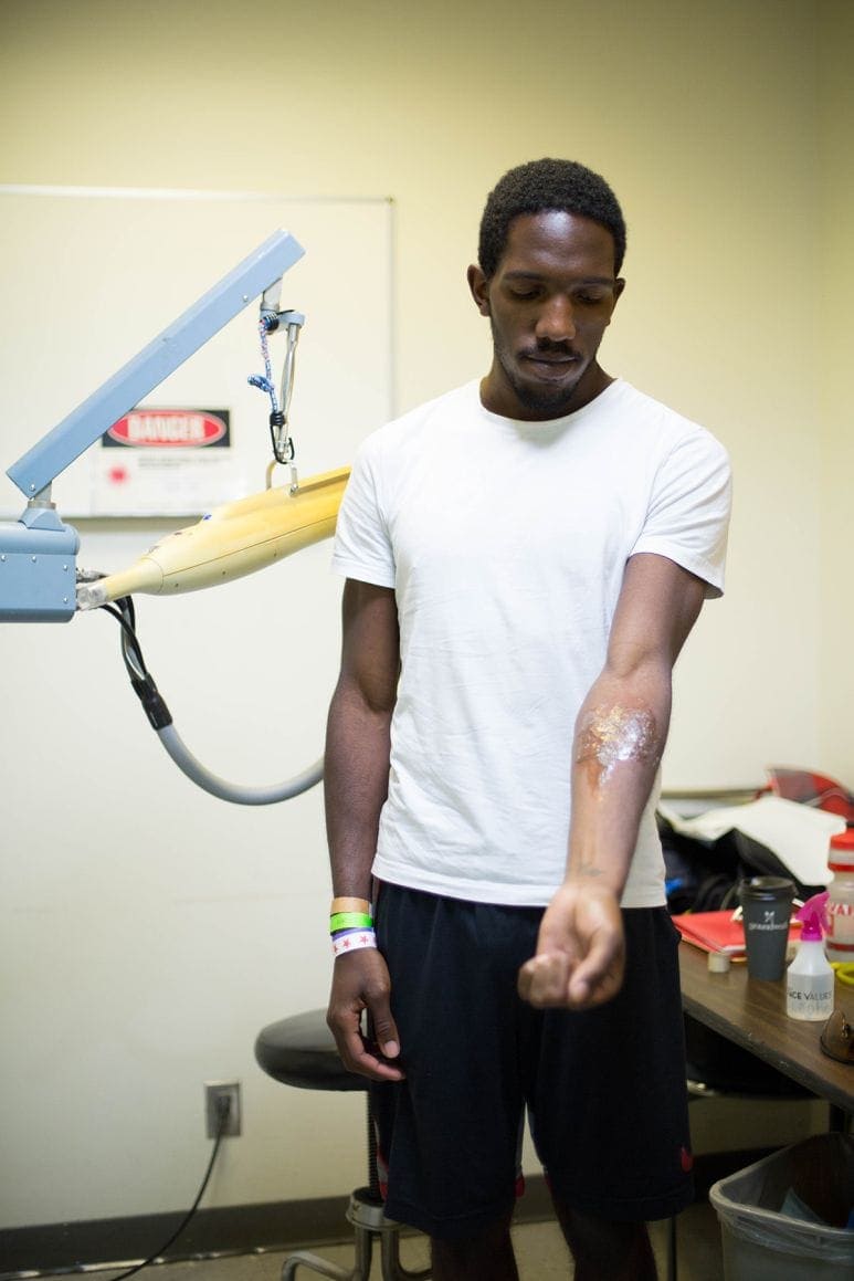 Jordan Overby showing where his tattoo used to be before he got it removed at the mega-clinic. (Tanya Musgrave / NAD)